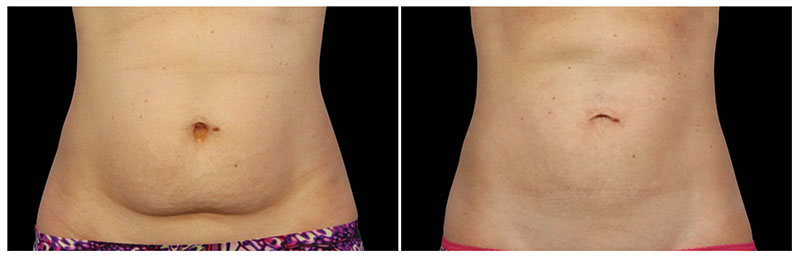before and after coolsculpting photos
