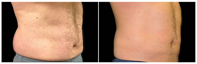 before and after coolsculpting photos